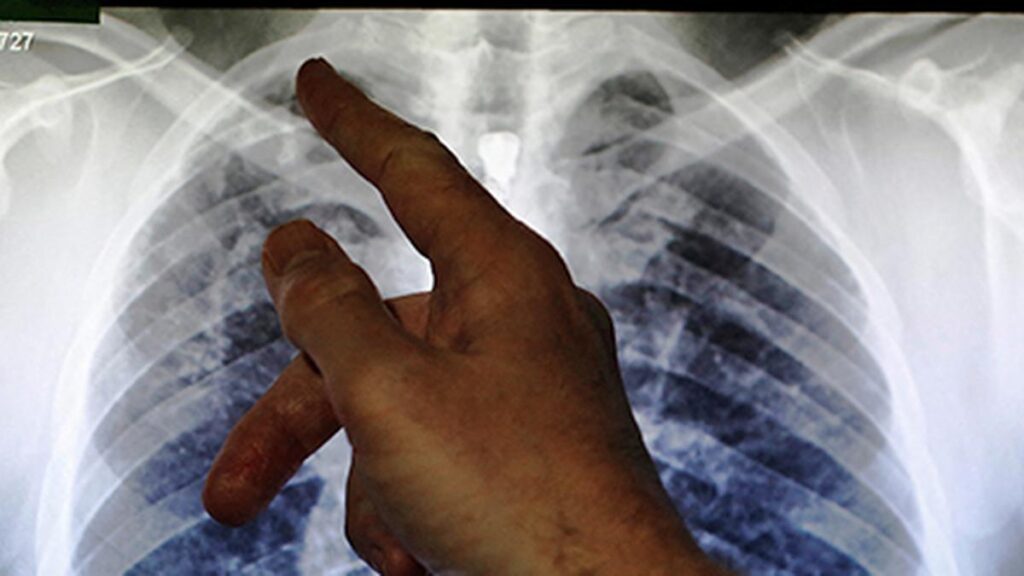 44 die of TB this year in Mizoram: officials