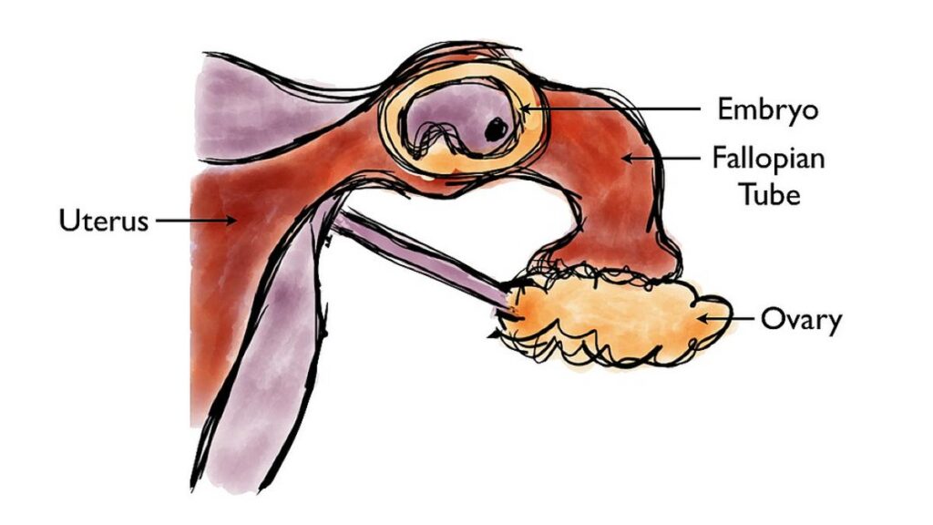 All you need to know about: ectopic pregnancies