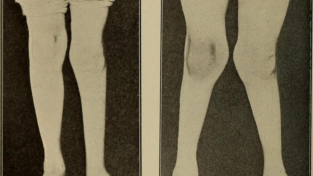 Improving paediatric bone health through growth modulation
