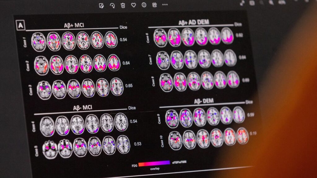 Lithium deficiency could lead to Alzheimer's, study suggests