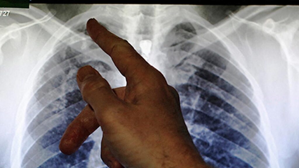 Maharashtra Health Department integrates TB screening into medical college family adoption programmes