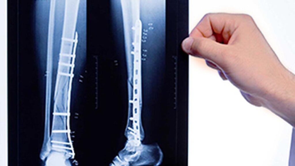 Men and osteoporosis: busting the myth that only women are at risk