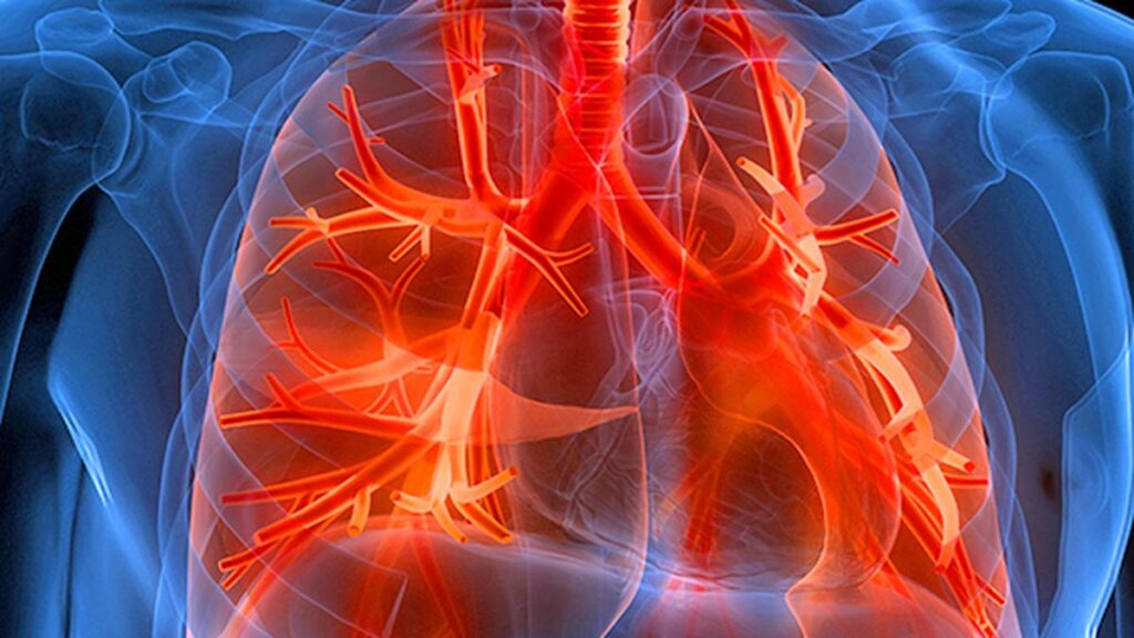 Precigen shares jump after U.S. FDA approves first therapy for rare respiratory disease