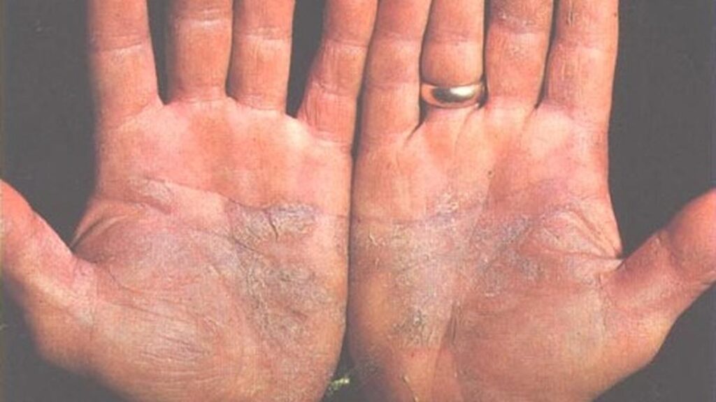 Psoriasis cases are on the rise, say dermatologists. What are the causes and how do you treat the condition?