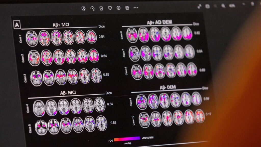 Researchers say routine eye tests may reveal signs of Alzheimer’s before symptoms appear Researchers say routine eye tests may reveal signs of Alzheimer's before symptoms appear