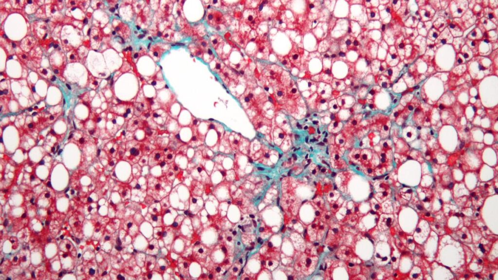 The urgent need to combat the epidemic of fatty liver in India