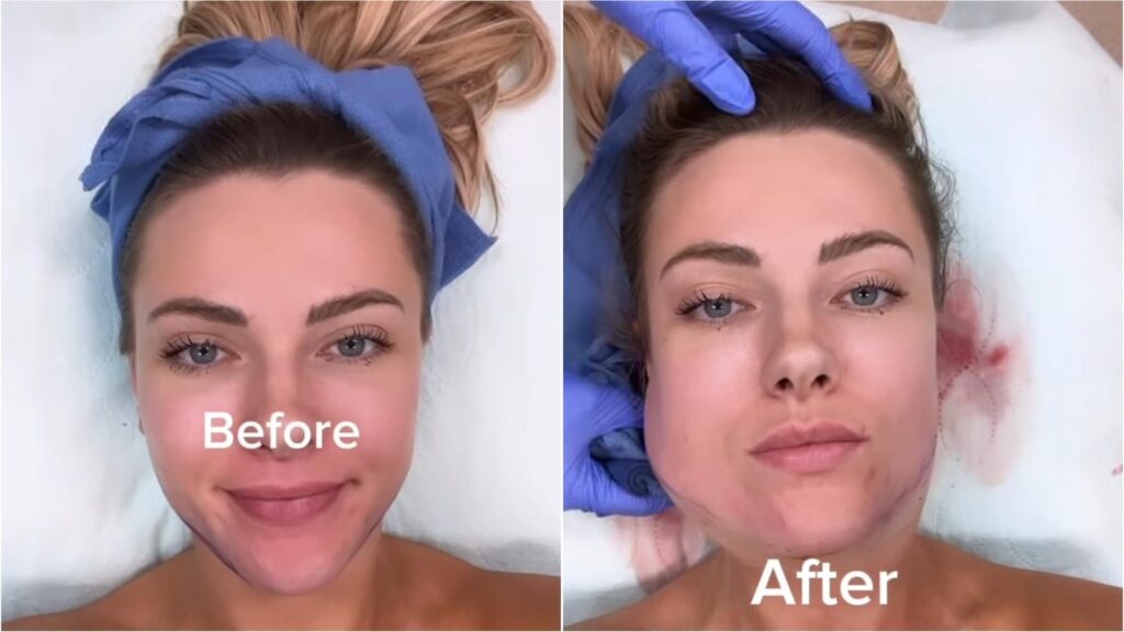 Woman's cosmetic surgery goes terribly wrong after filters distorted her self-image: ‘I thought I had a double chin’ | Health