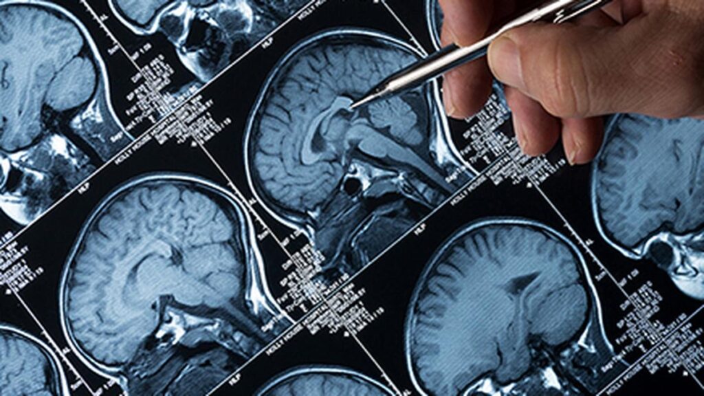 Healthcare reforms required globally to match progress in diagnosis, treatment of Alzheimer's disease: researchers