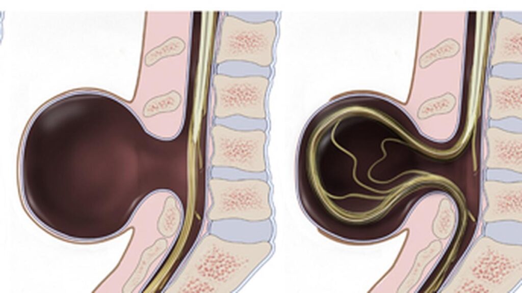 All you need to know about: spina bifida