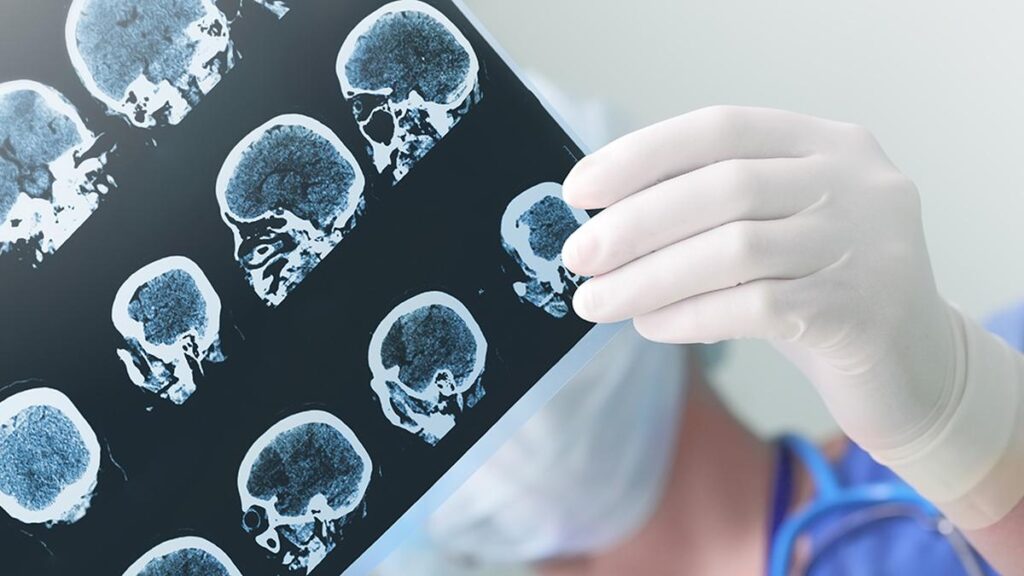 Brain tumours: how much we’ve leant invert the years