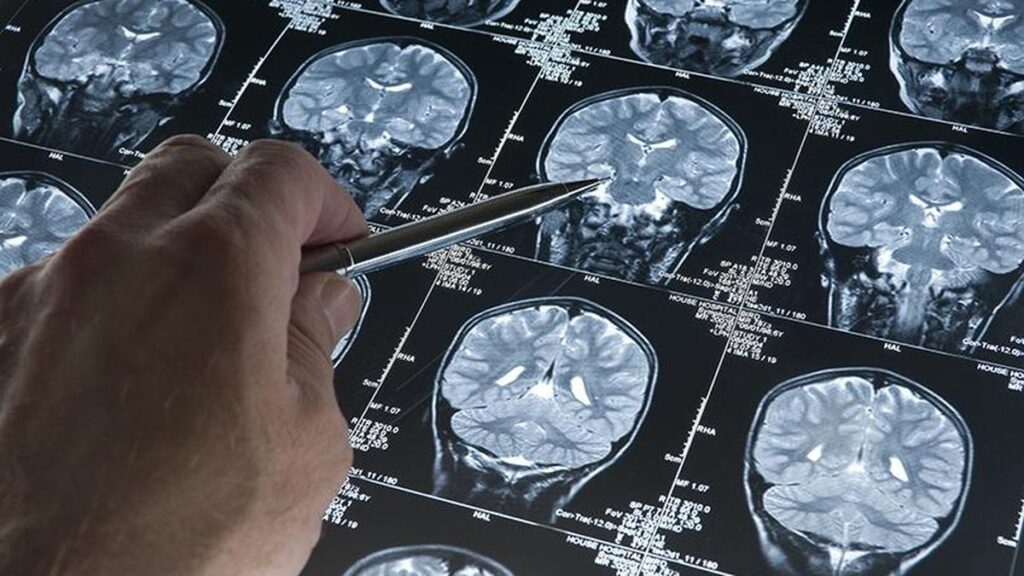 The urgent need to bring stroke rehabilitation into the mainstream